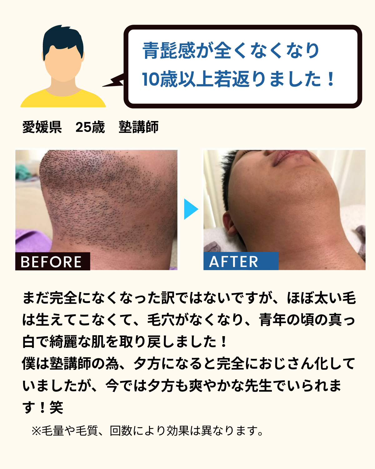 青髭感が全くなくなり10歳以上若返りました!愛媛県 25歳 塾講師。まだ完全になくなった訳ではないですが、ほぼ太い毛が生えてこなくて、毛穴がなくなり、青年の頃の真っ白で綺麗な肌を取り戻しました!僕は塾講師の為、夕方になると完全におじさん化していましたが、今では夕方も爽やかな先生でいられます!笑 ※毛量や毛質、回数により効果は異なります。